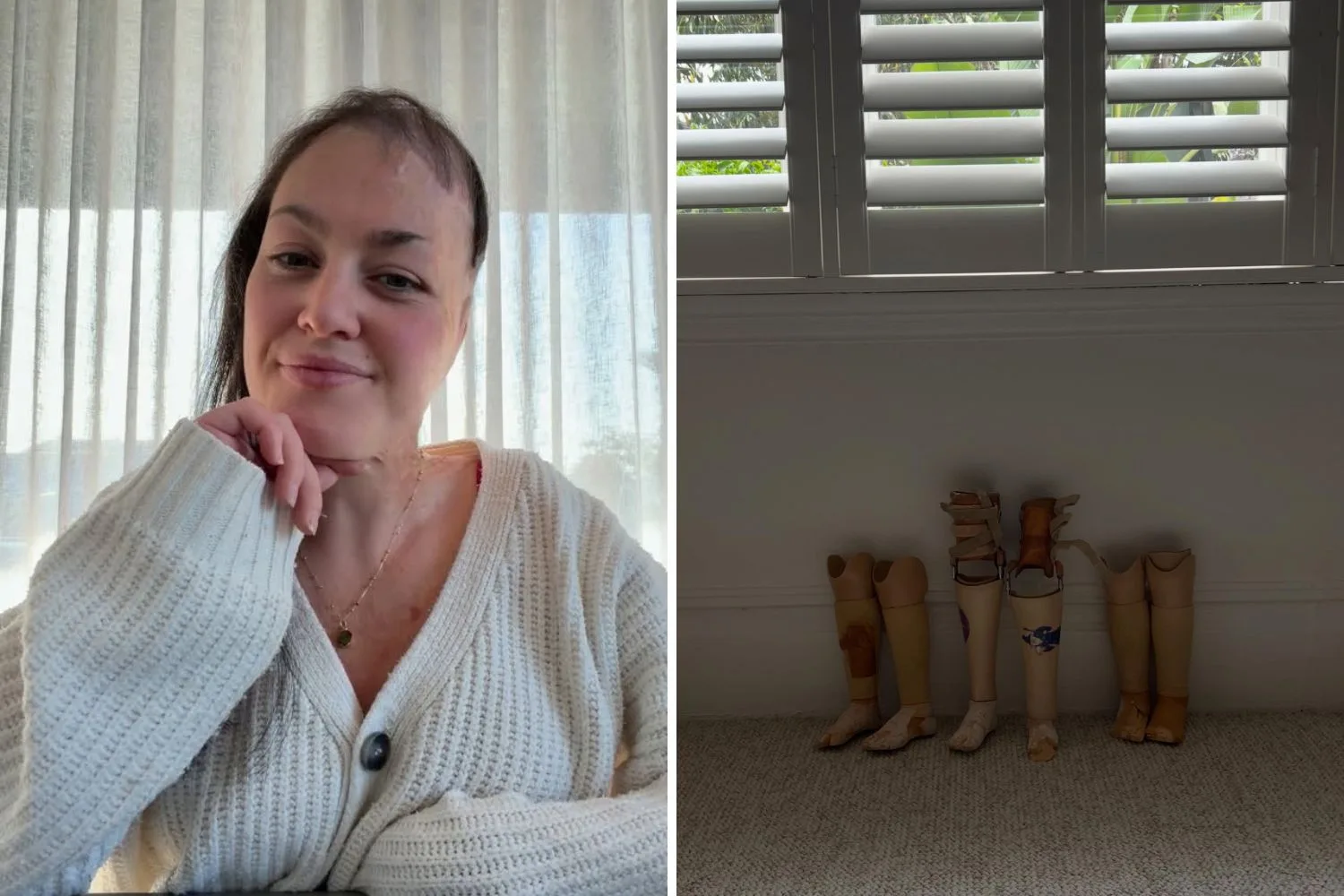 Sophie Delezio and her prosthetics