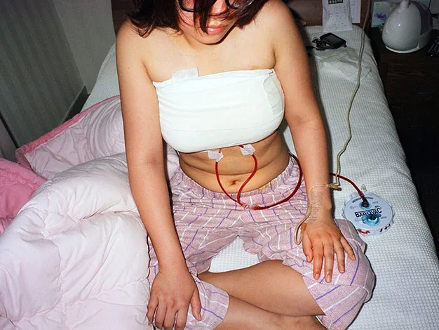 Woman sitting on bed post-surgery, chest wrapped in bandages, with medical tubes connected to a drain device.