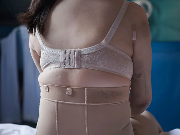 A person sits with their back to the camera, wearing a bra and supportive garment, with medical bandages on their arm.
