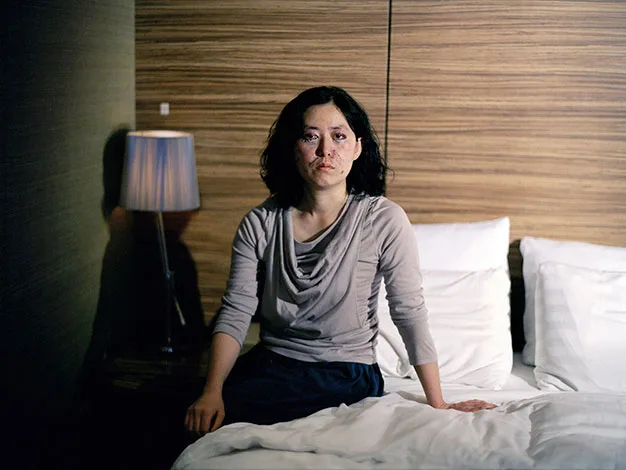 A woman with facial burns sits on a bed in a softly lit room, wearing a long-sleeve top.
