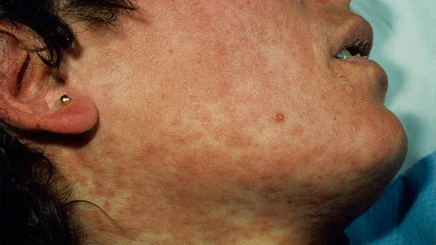 The red measles rash, stock image