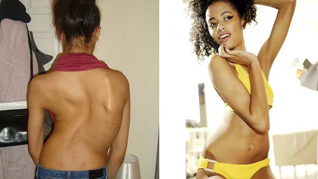 Ayesha Jones models with scholiosis