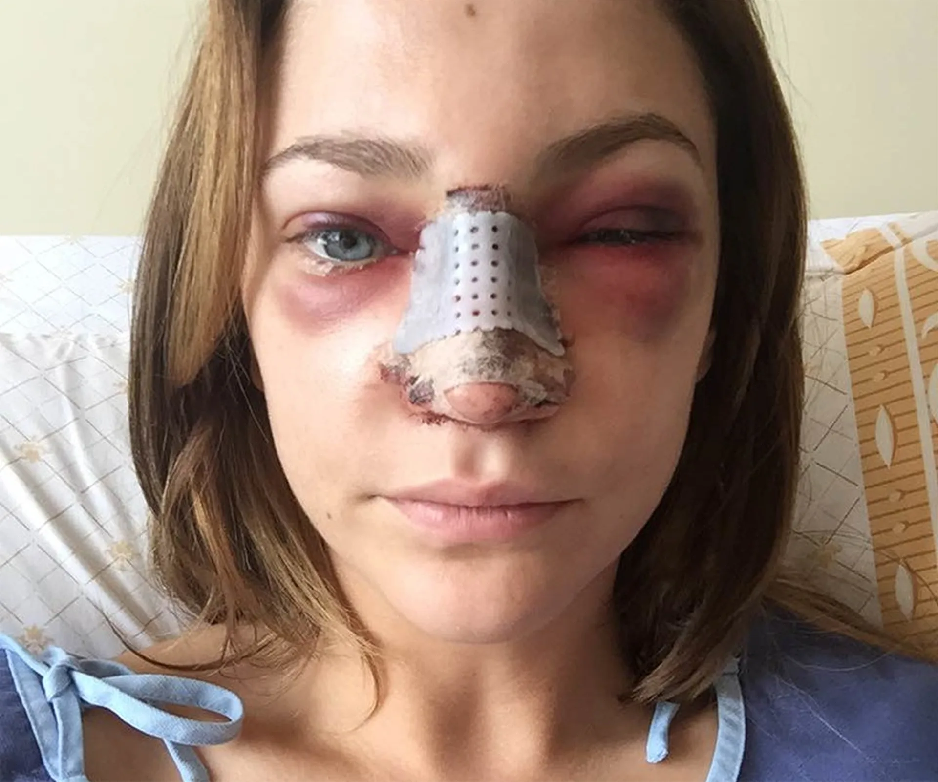A woman post-nose job with bandage and swelling on her face, lying on a pillow.