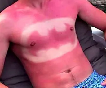 Sunburned torso displaying a Batman logo pattern in varying shades of red and white.