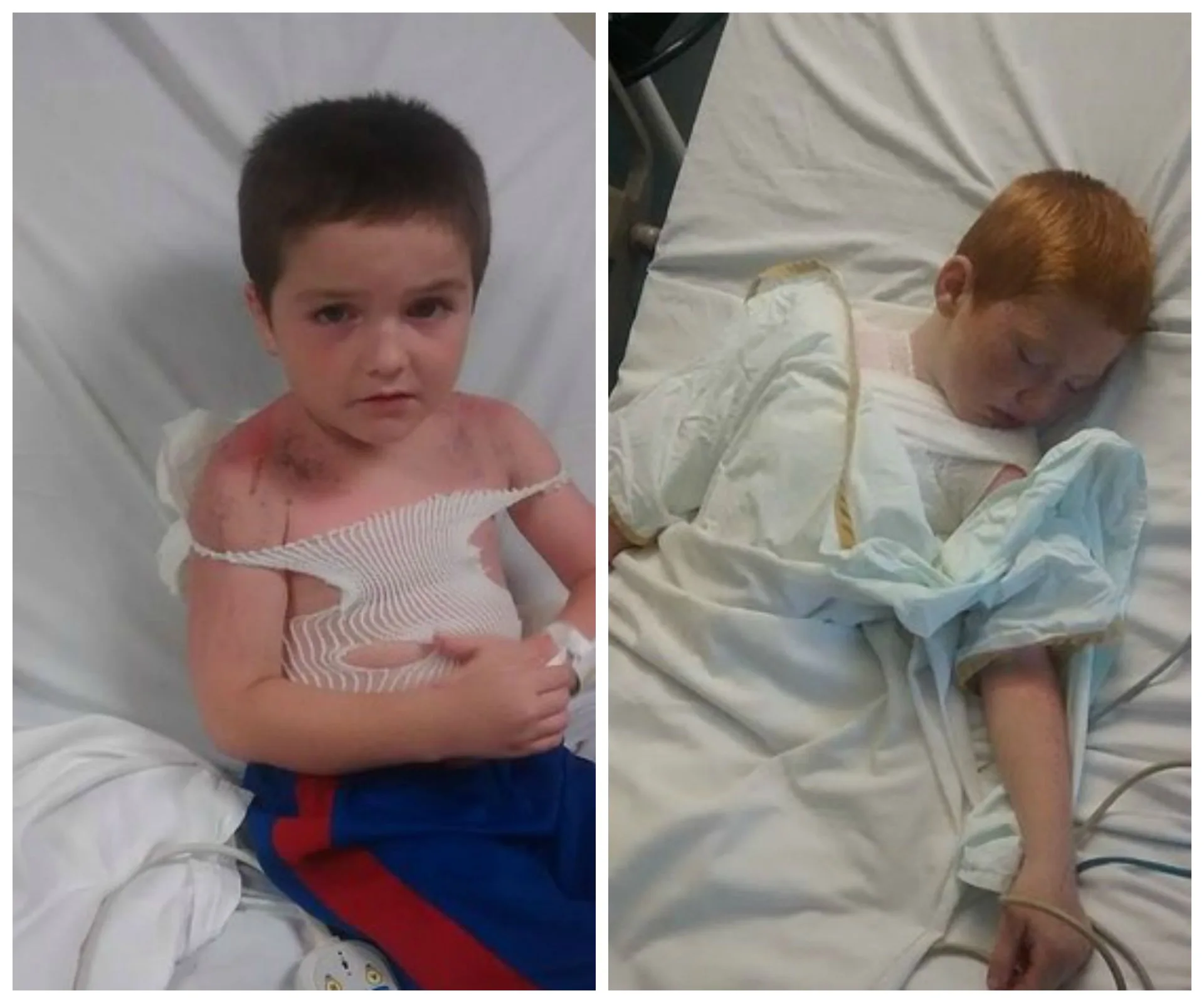 Boys in hospital beds recovering from burns, showing visible injuries and medical bandages.
