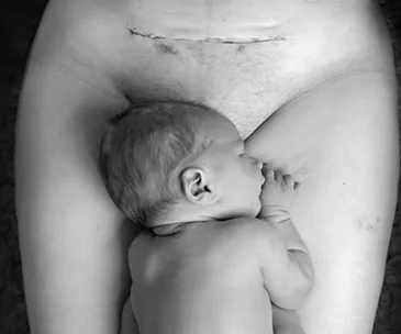 A newborn baby lies on a mother's lap with a visible C-section scar.