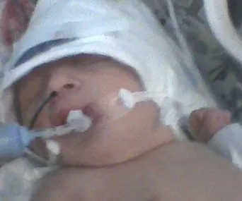 Newborn baby with medical tubes and bandages, lying in a hospital crib.