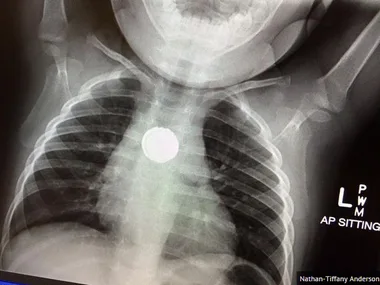 X-ray showing a round battery lodged in a toddler's esophagus.