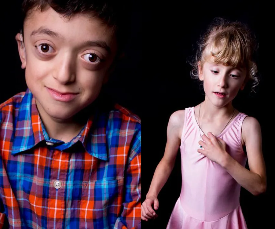 Rarest Disability The Rare Project: woman photographs rare disabilities