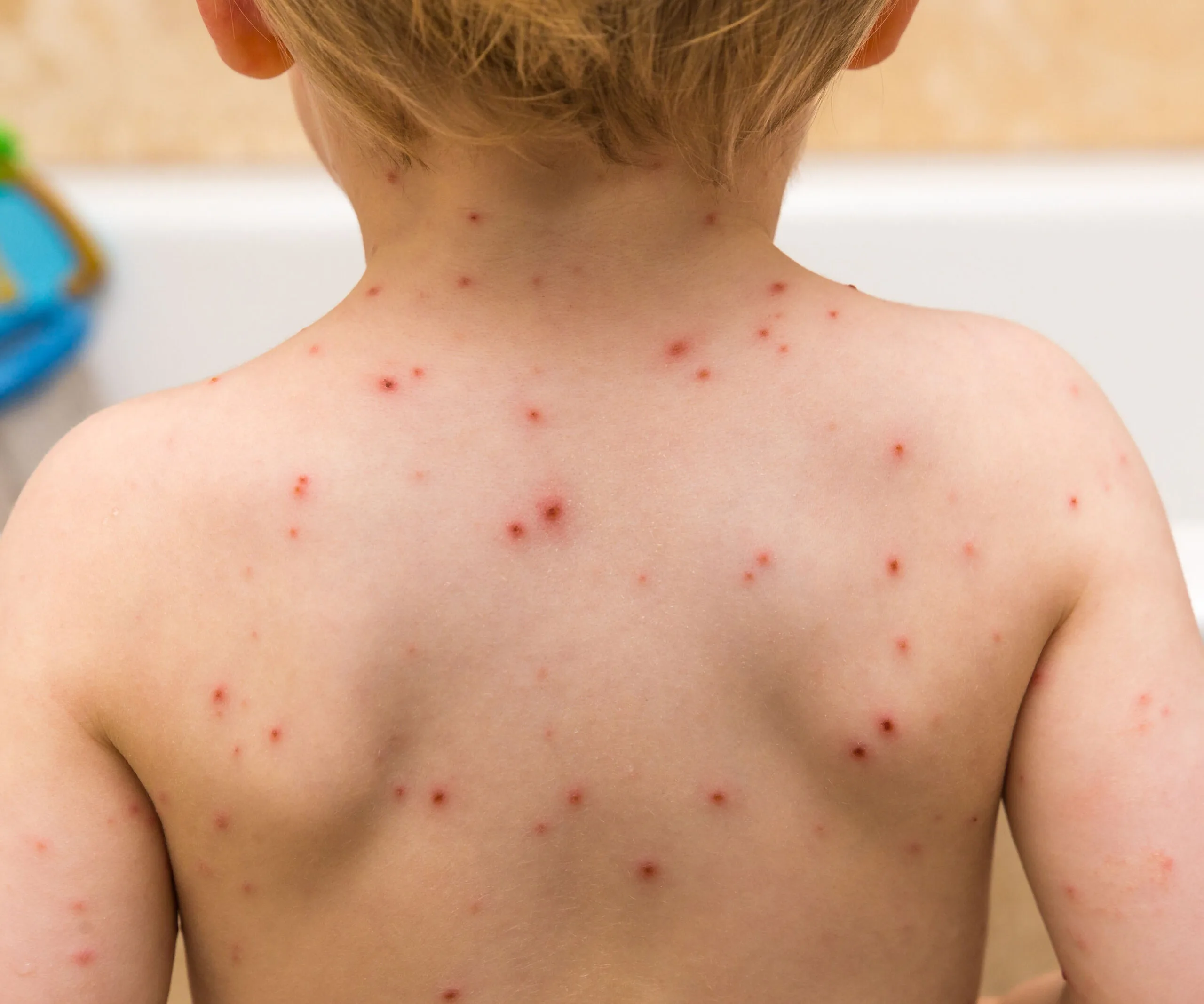 child with chicken pox