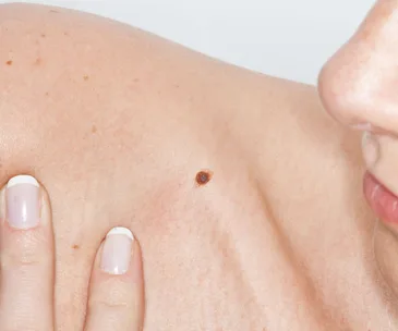 Close-up of a person's shoulder with fingers examining a dark mole on the skin.
