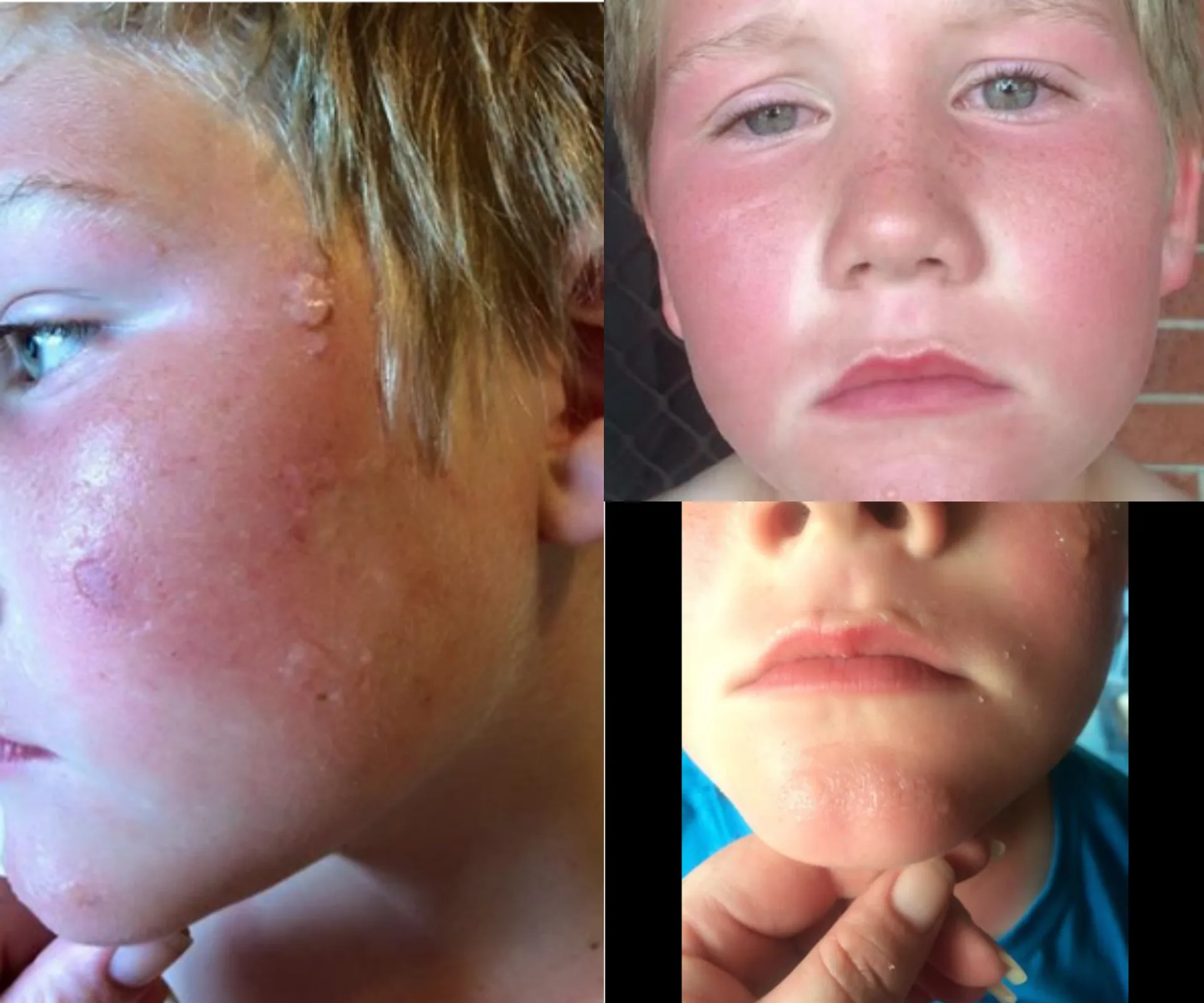 Boy with red, irritated skin and blisters on face due to sunscreen reaction.