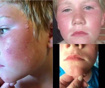 Boy with red, irritated skin and blisters on face due to sunscreen reaction.