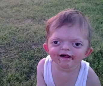 Child with a genetic condition smiling outdoors in a grassy area.