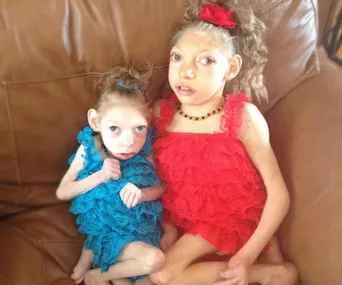 Two young girls with a rare condition sit on a couch, one in a blue dress and the other in a red dress.