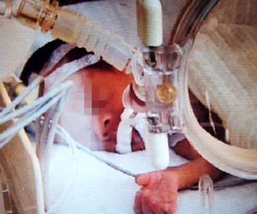 Newborn in intensive care surrounded by medical equipment, showing a pixelated face and small clenched hand.