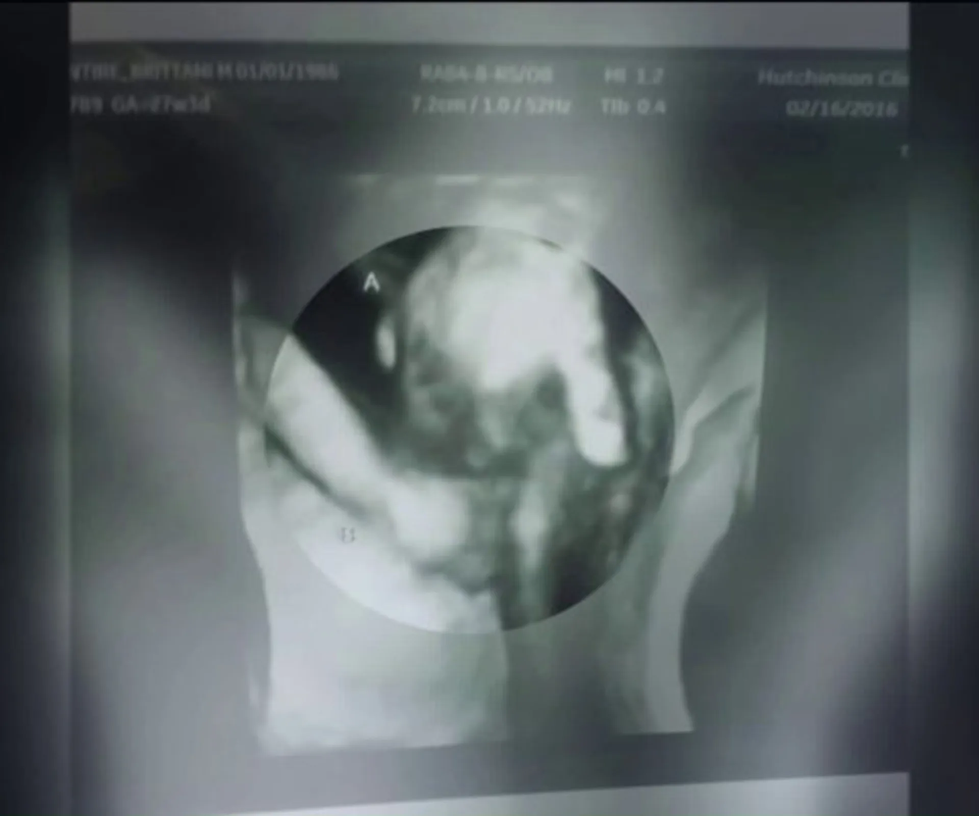 Sonogram image showing an unborn baby girl holding her dying twin brother's hand.