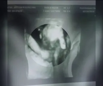 Sonogram image showing an unborn baby girl holding her dying twin brother's hand.