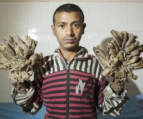 bangladesh's Tree Man