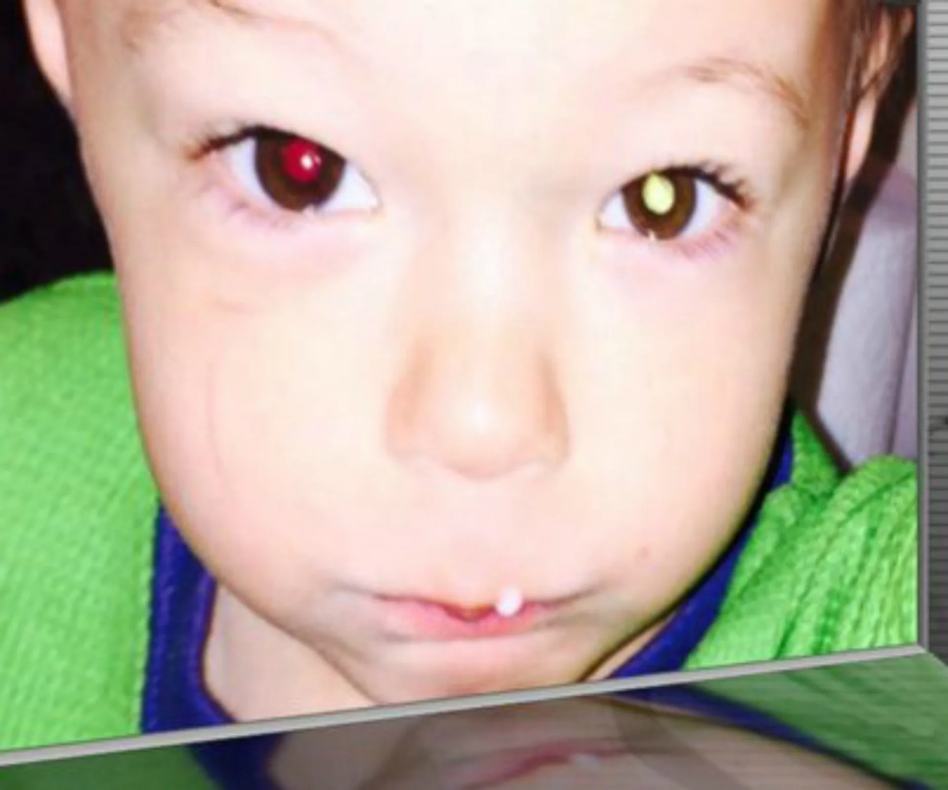Toddler with one eye reflecting white, indicating a potential sign of eye cancer.