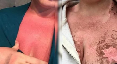 Woman's severely sunburned chest with peeling skin, highlighting sunscreen ineffectiveness.