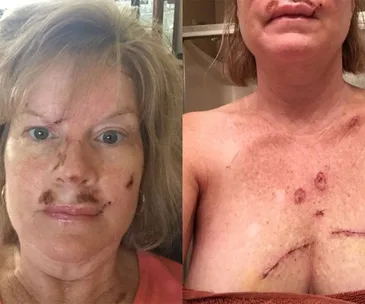 A woman with visible scars from skin cancer treatment on her face and chest, sharing her experience.
