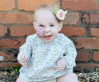 A baby with a birthmark on her cheek, wearing a floral headband and dress, sits in front of a brick wall smiling.