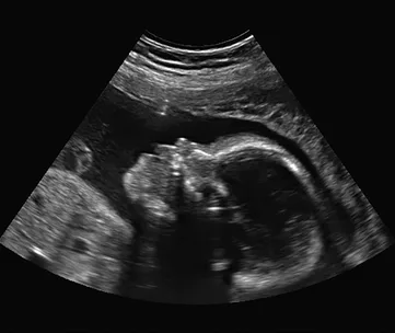Ultrasound image of a fetus in the womb, emphasizing why fake pregnancy jokes on April Fools' can be harmful.