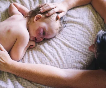 Powerful photography series celebrating those with port-wine birthmarks