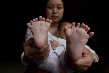 Baby held by a woman showing feet with extra toes, highlighting polydactyly condition.