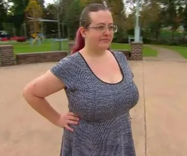 Sydney woman claims dole because of large breasts