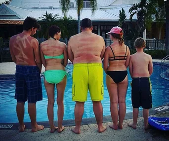 Family of five stands by the pool with funny sunburn patterns on their backs in swimsuits.