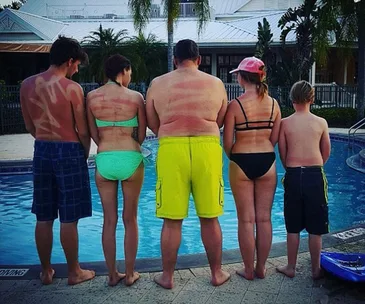 Family’s hilarious sunburn fail
