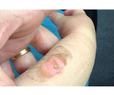 A close-up of a toddler's arm with a visible burn injury, showing pink and healing skin.