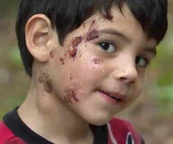 A young boy with injuries and scabs on his cheek, wearing a red and black shirt, looking towards the camera.