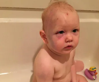 A toddler with visible bruises sits in a bathtub next to a purple rubber duck.