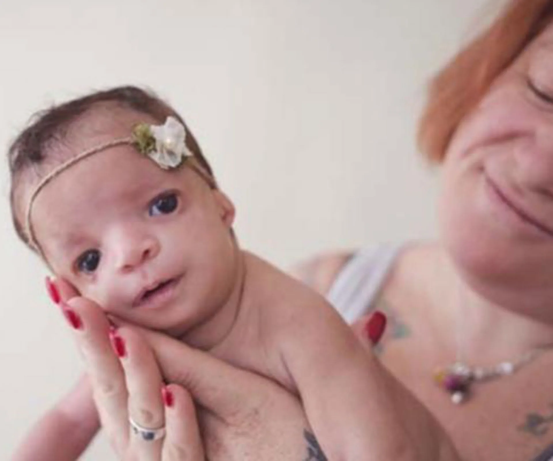 A baby with a birth defect wearing a headband, held tenderly by a woman, who smiles gently in the background.