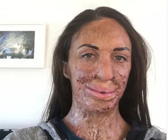 Turia Pitt smiling post-surgery with visible burn scars on her face, wearing a hoodie indoors.