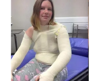 Woman in full upper body bandages and pajamas, sitting on a hospital bed.