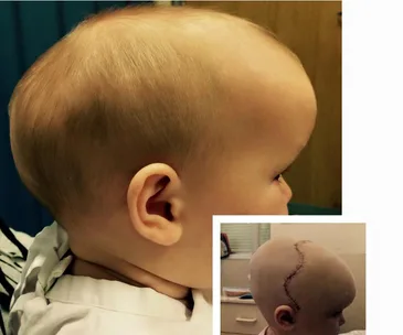 Profile of a baby with craniosynostosis, inset shows post-surgery scar on the head.