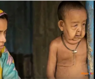 Toddler with premature aging condition stands against a door, with a woman beside him.