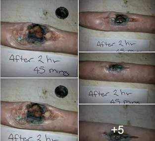 A series of images showing battery burns on simulated skin after exposure, labeled with time intervals.