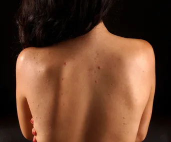 Back view of a person with acne on their skin, highlighting skin imperfections.