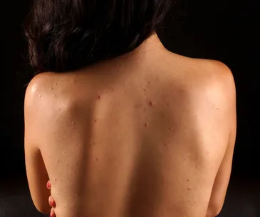 Back view of a person with acne on their skin, highlighting skin imperfections.