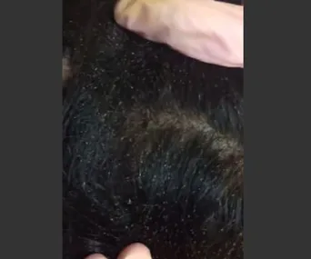 Close-up of a person's scalp infested with head lice, showing numerous lice and nits among dark hair.