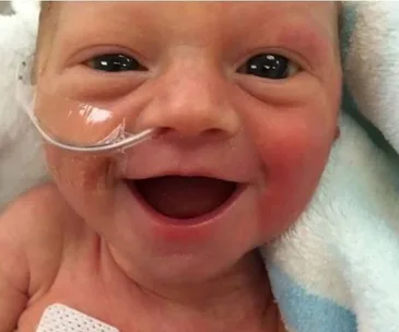 Smiling premature baby with oxygen tube in hospital, wrapped in a soft blanket.