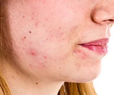 Close-up of a person's lower face with visible acne and blemishes on the cheek and chin.