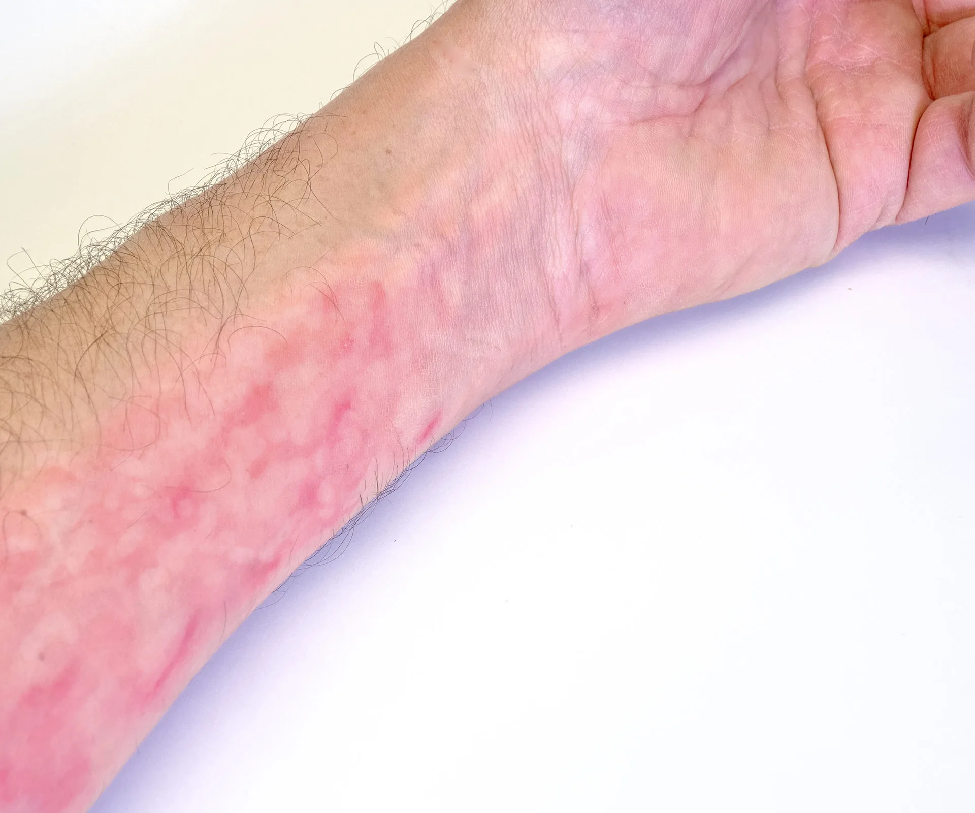 A forearm with a red rash, possibly indicating a symptom of meningococcal disease, on a white background.