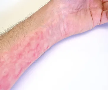 A forearm with a red rash, possibly indicating a symptom of meningococcal disease, on a white background.