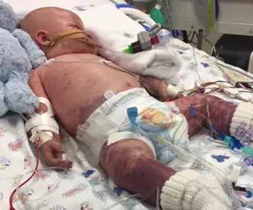 Baby in hospital with tubes and IV lines, showing serious condition; covered in spots from meningococcal infection.